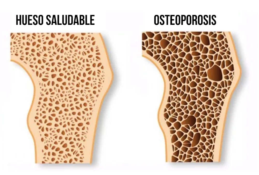 Osteoporosis